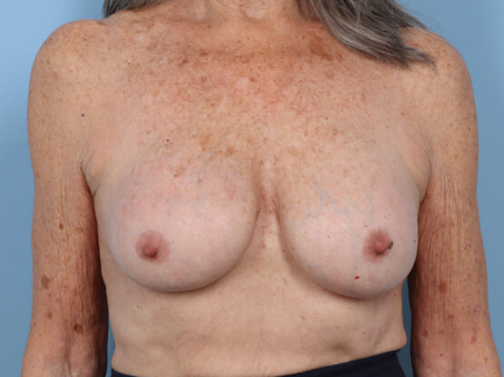 Case # 32 after photo