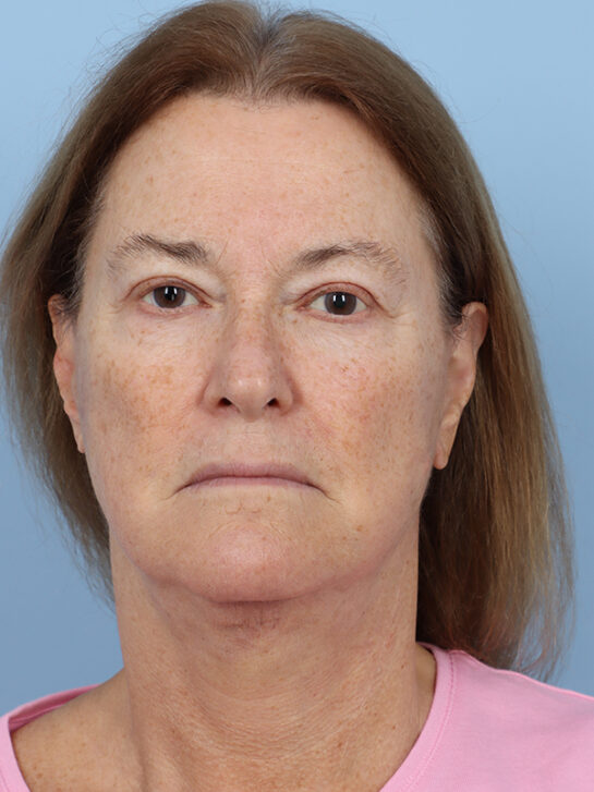 Case # 34 after photo