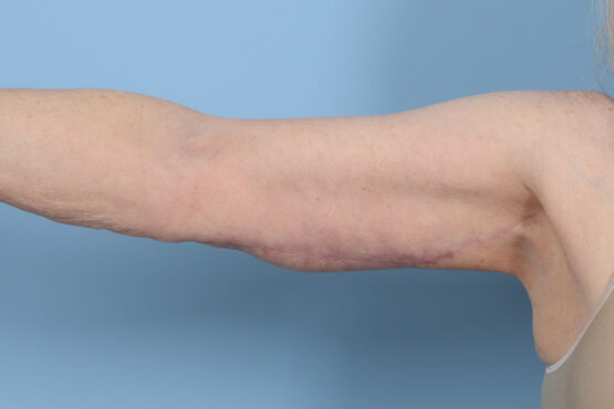 Case # 5 after photo