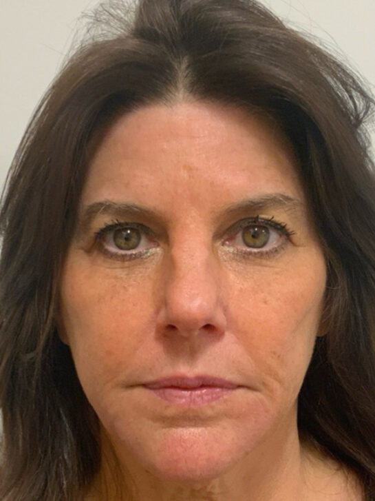 Case # 34 after photo