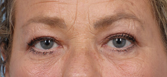 Case # 4 after photo