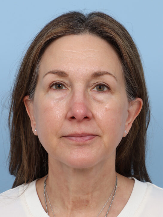 Case # 36 after photo