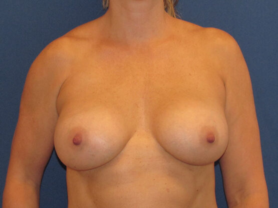 Case # 1 after photo