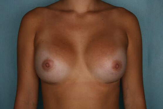 Case # 11 after photo