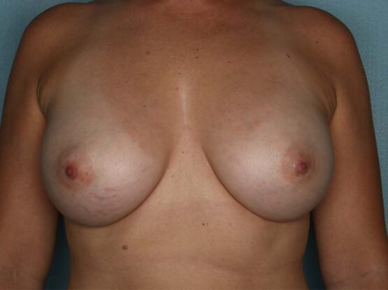 Case # 21 after photo