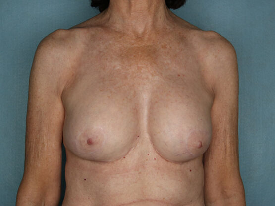 Case # 22 after photo