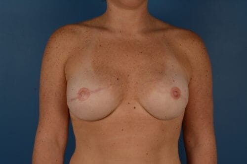 Case # 10 after photo