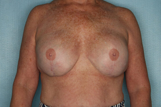 Case # 13 after photo