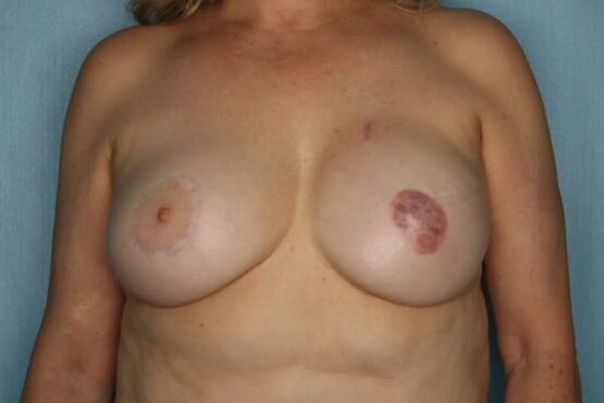 Case # 15 after photo