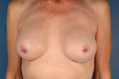 Case # 6 after photo