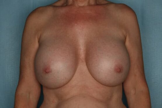 Case # 8 after photo