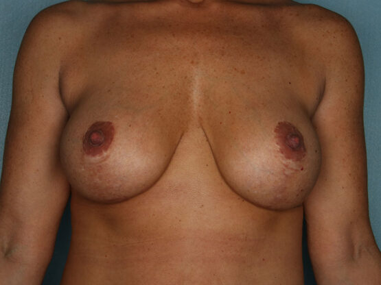 Case # 11 before photo