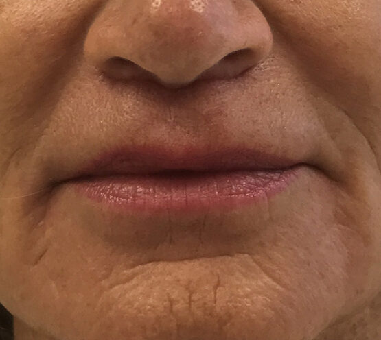 Case # 1 after photo