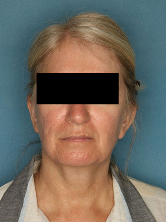 Case # 1 before photo