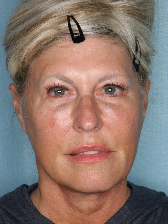 Case # 2 after photo