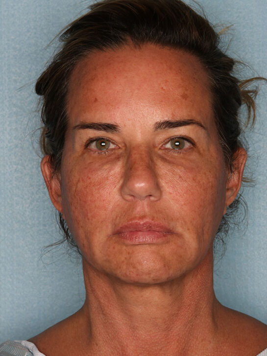 Case # 3 after photo