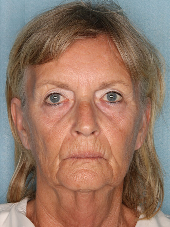 Case # 5 before photo