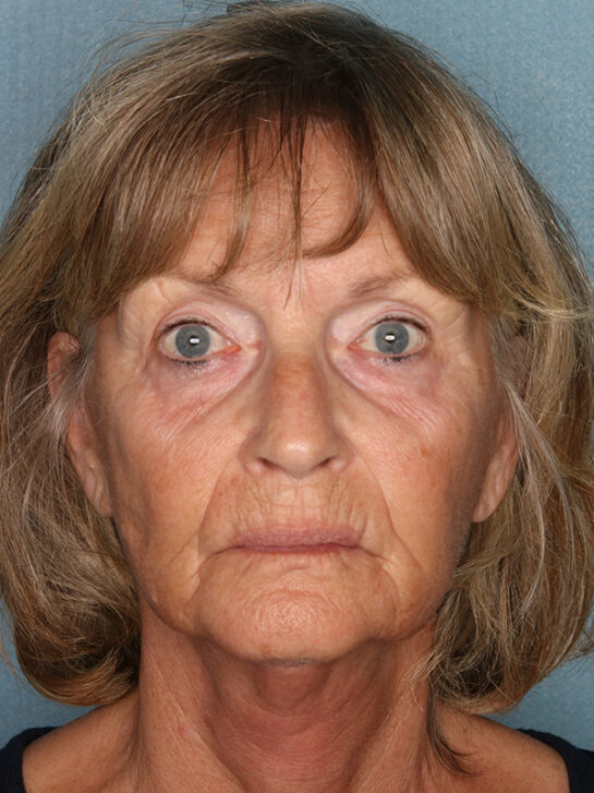 Case # 5 after photo