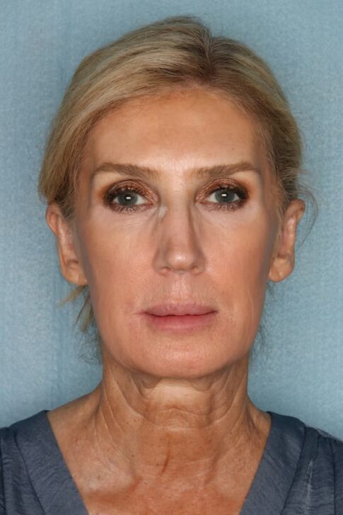 Case # 6 before photo