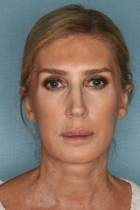 Case # 6 after photo