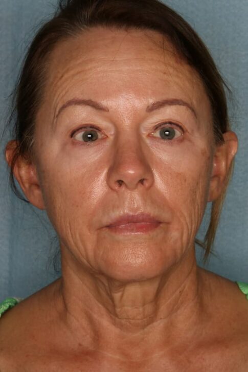 Case # 8 before photo