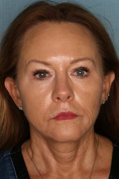 Case # 8 after photo