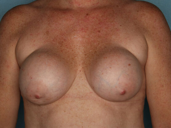 Case # 14 before photo