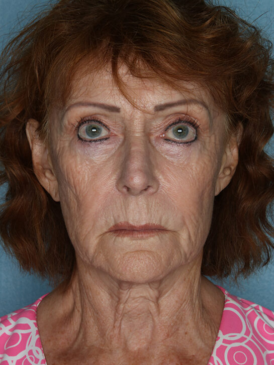 Case # 9 before photo