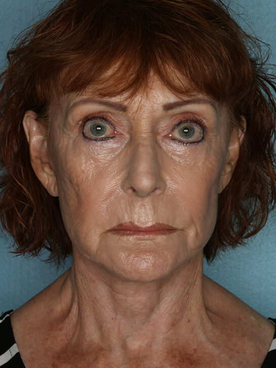 Case # 9 after photo