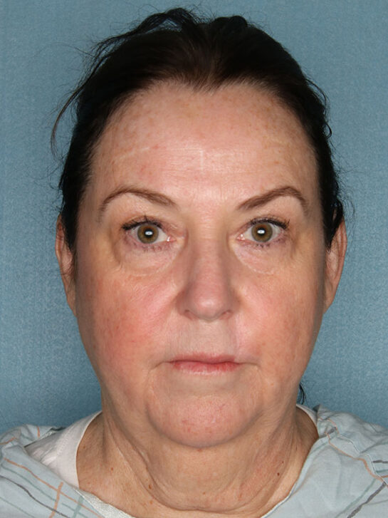 Case # 10 before photo