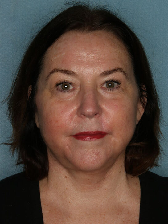 Case # 10 after photo