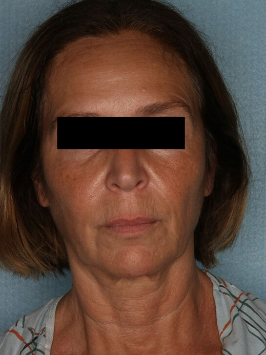 Case # 11 before photo