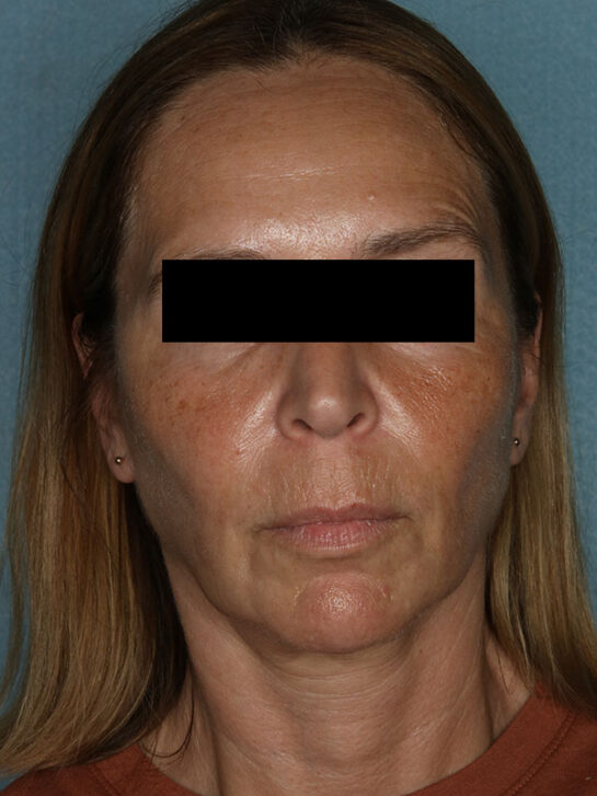 Case # 11 after photo