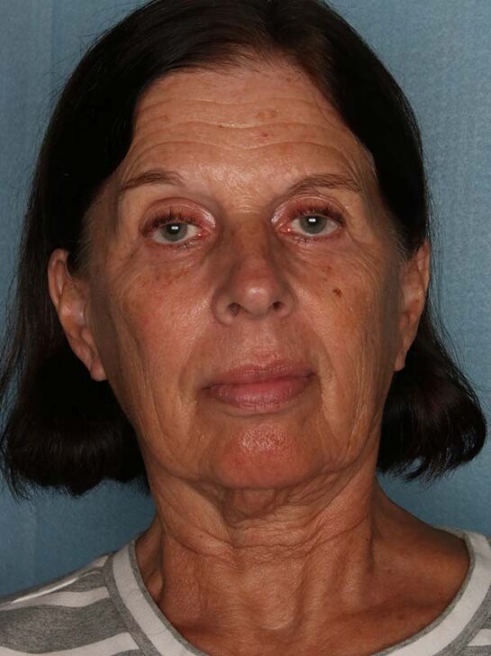 Case # 12 before photo