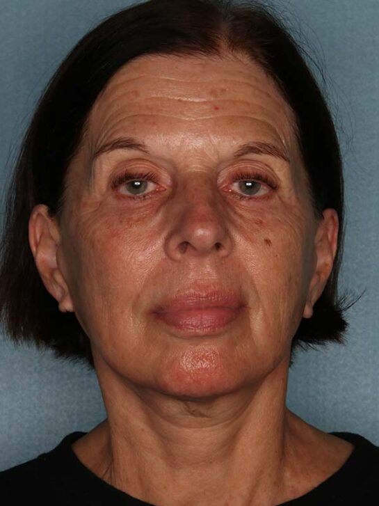 Case # 12 after photo