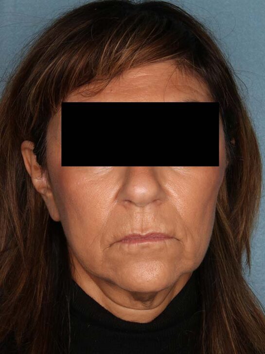 Case # 13 before photo