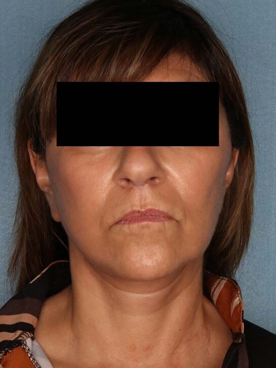 Case # 13 after photo