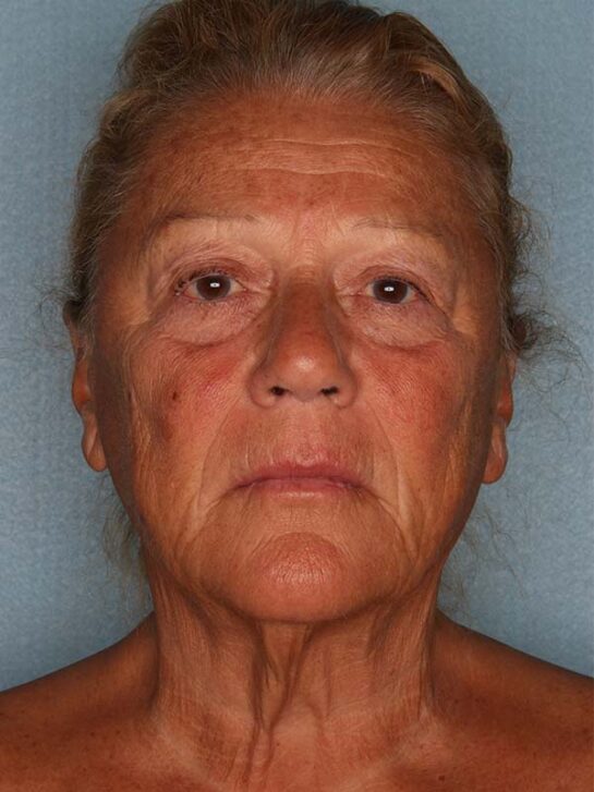 Case # 14 before photo