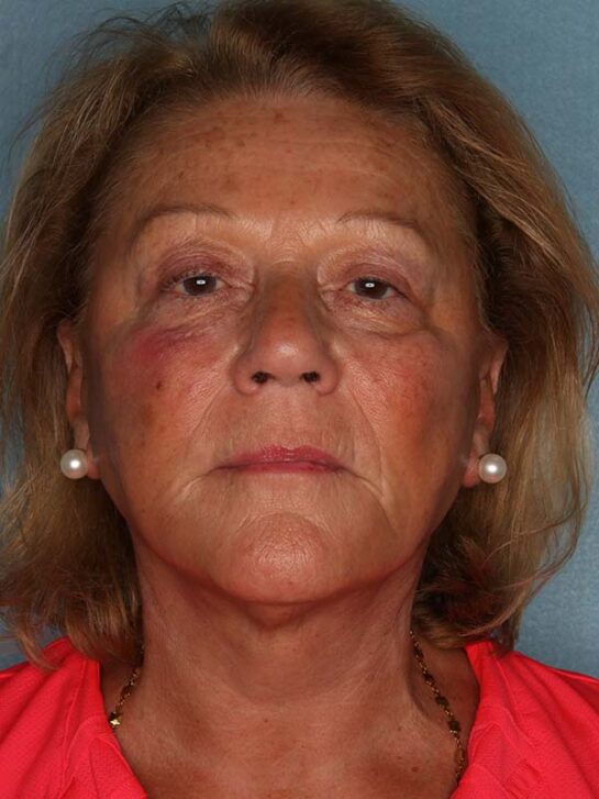 Case # 14 after photo