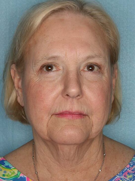 Case # 15 before photo