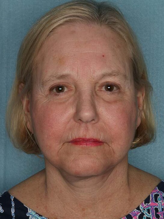 Case # 15 after photo