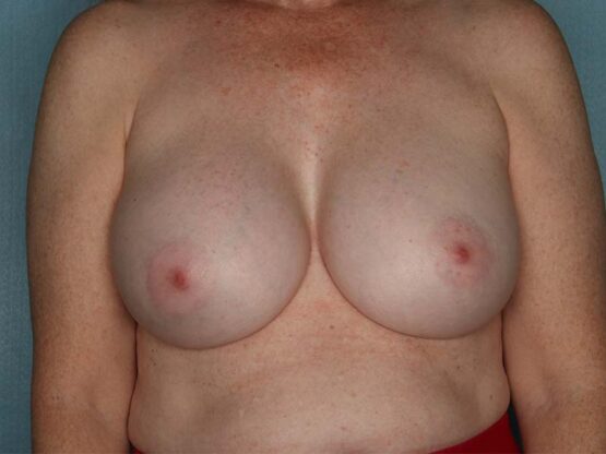 Case # 18 after photo