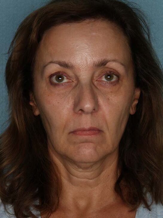 Case # 16 before photo