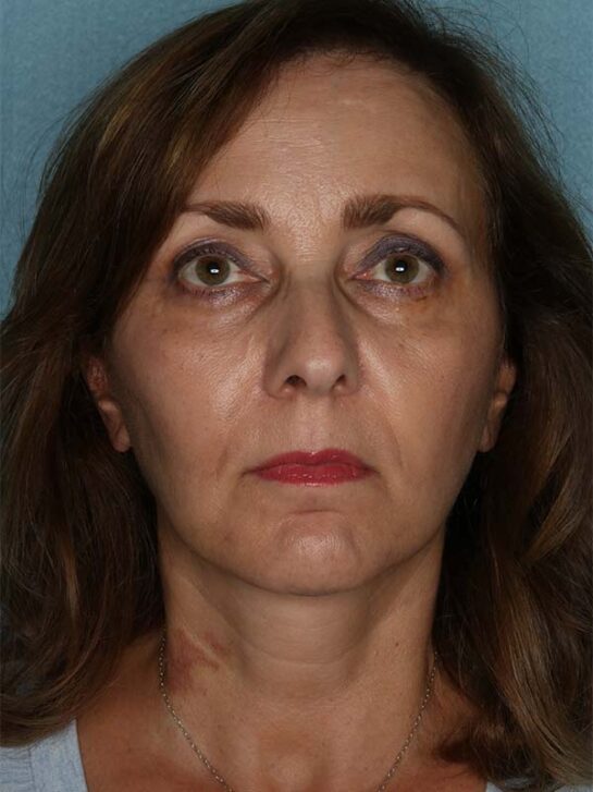 Case # 16 after photo