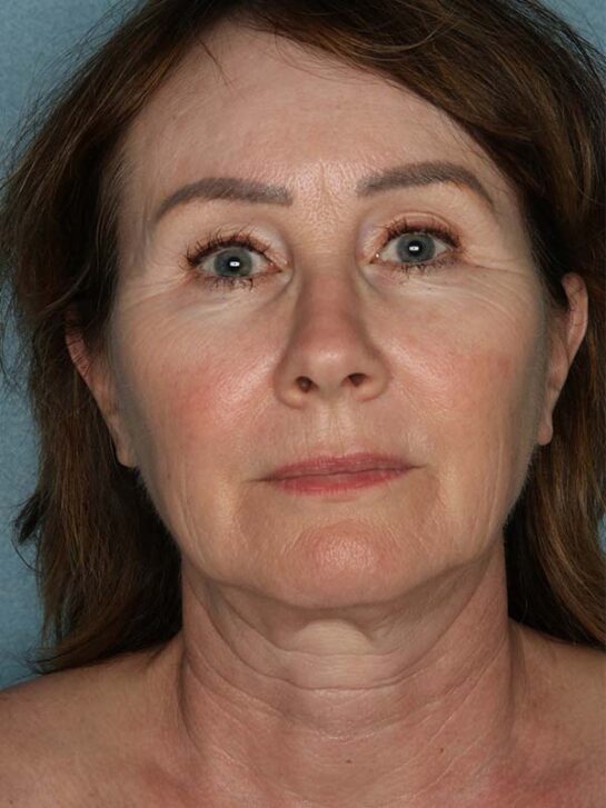 Case # 17 before photo