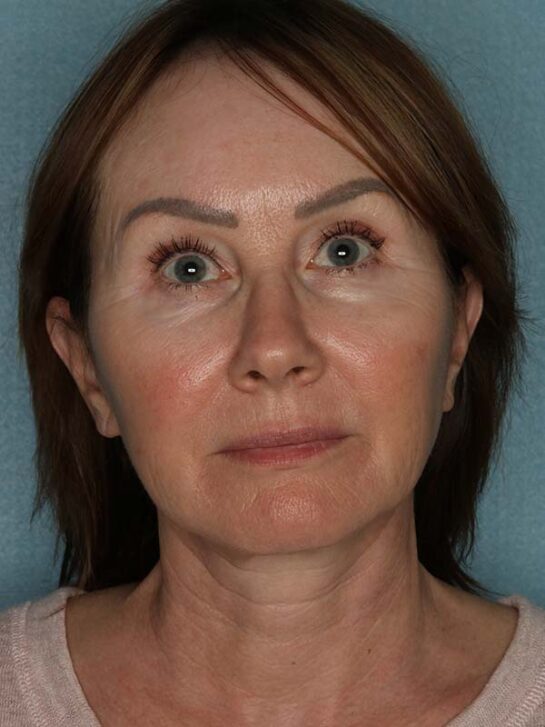 Case # 17 after photo