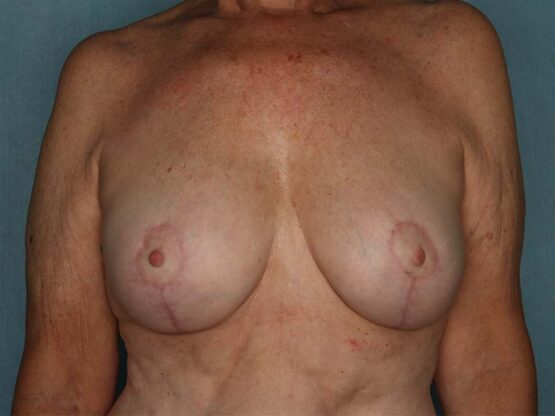 Case # 20 after photo