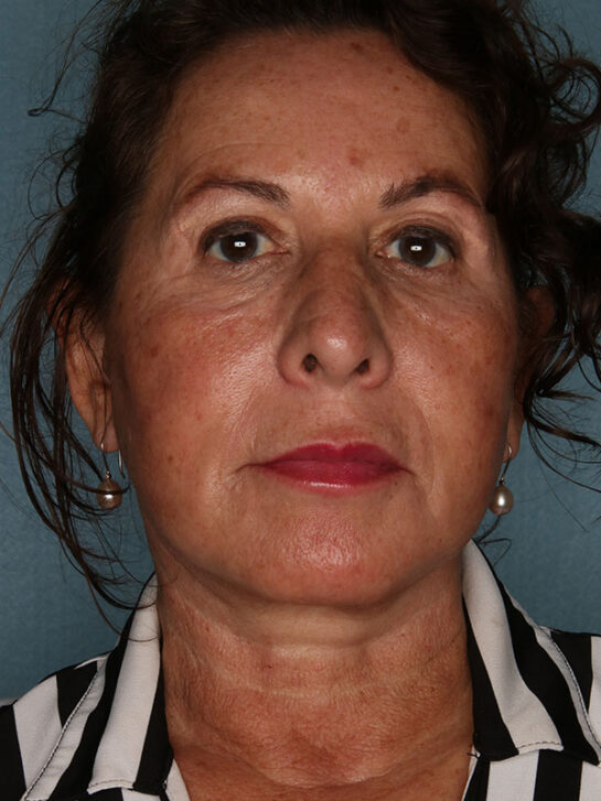 Case # 19 after photo