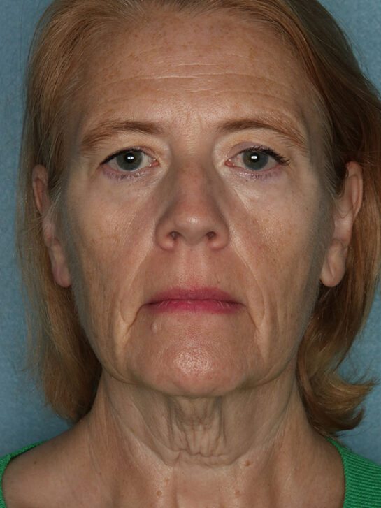 Case # 20 before photo