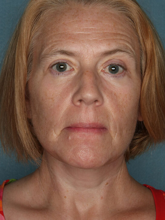 Case # 20 after photo